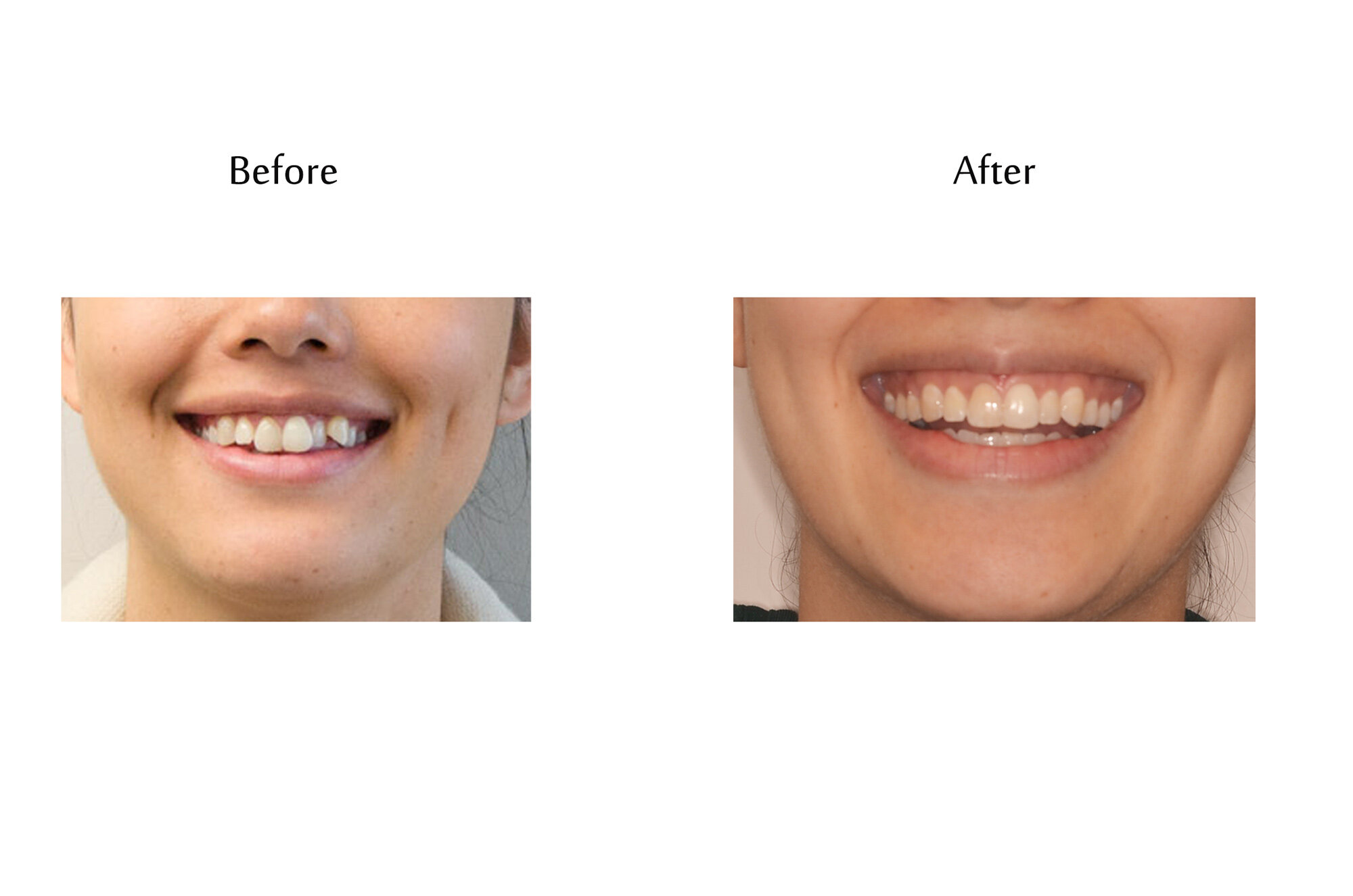 before-after-invisalign-2.jpg