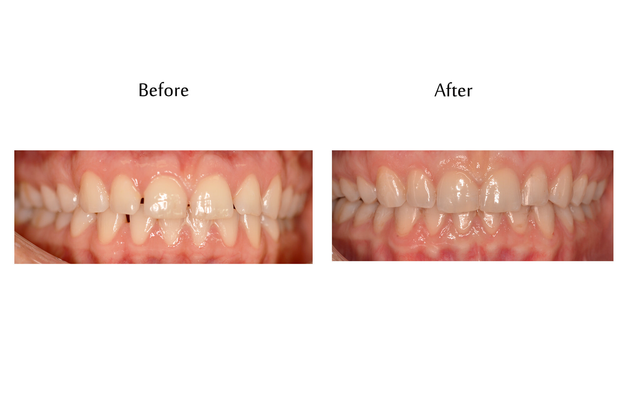 before-after-invisalign.jpg